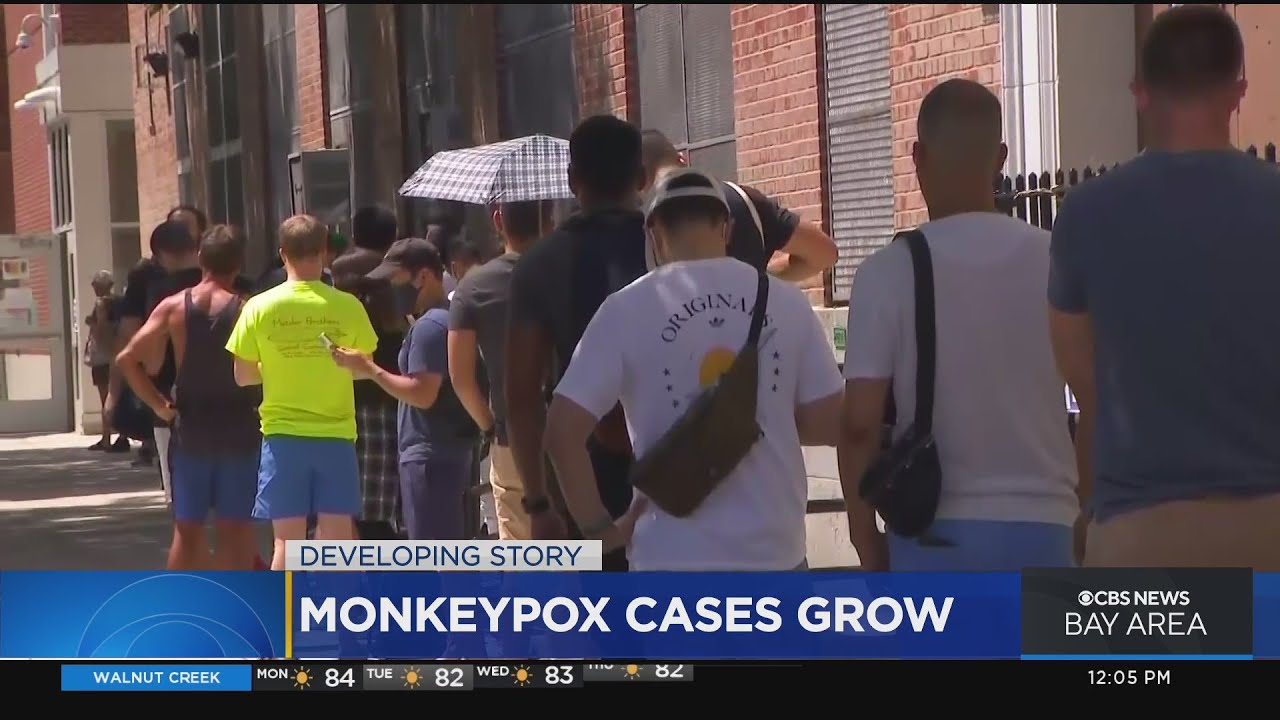 Cases Of Monkeypox Grow Across California And The U.s.