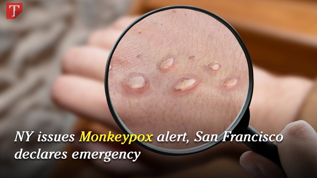 Ny Issues Monkeypox Alert, San Francisco Declares Emergency