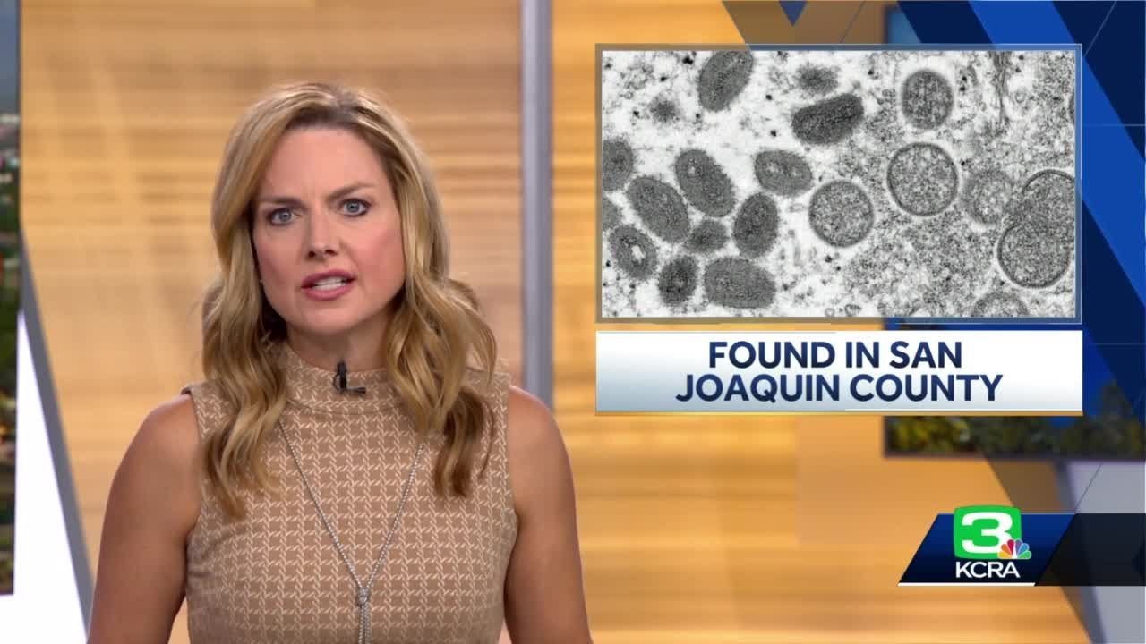 San Joaquin County Reports First Probable Monkeypox Case, Health Officials Say
