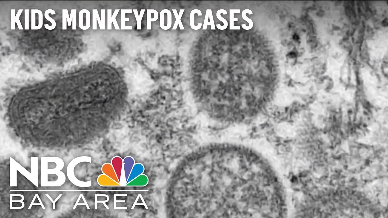 Two Children In Us Diagnosed With Monkeypox: Officials