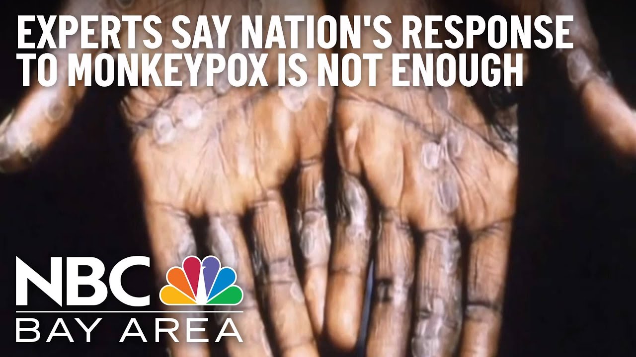 Bay Area Doctors React To Federal Monkeypox Response