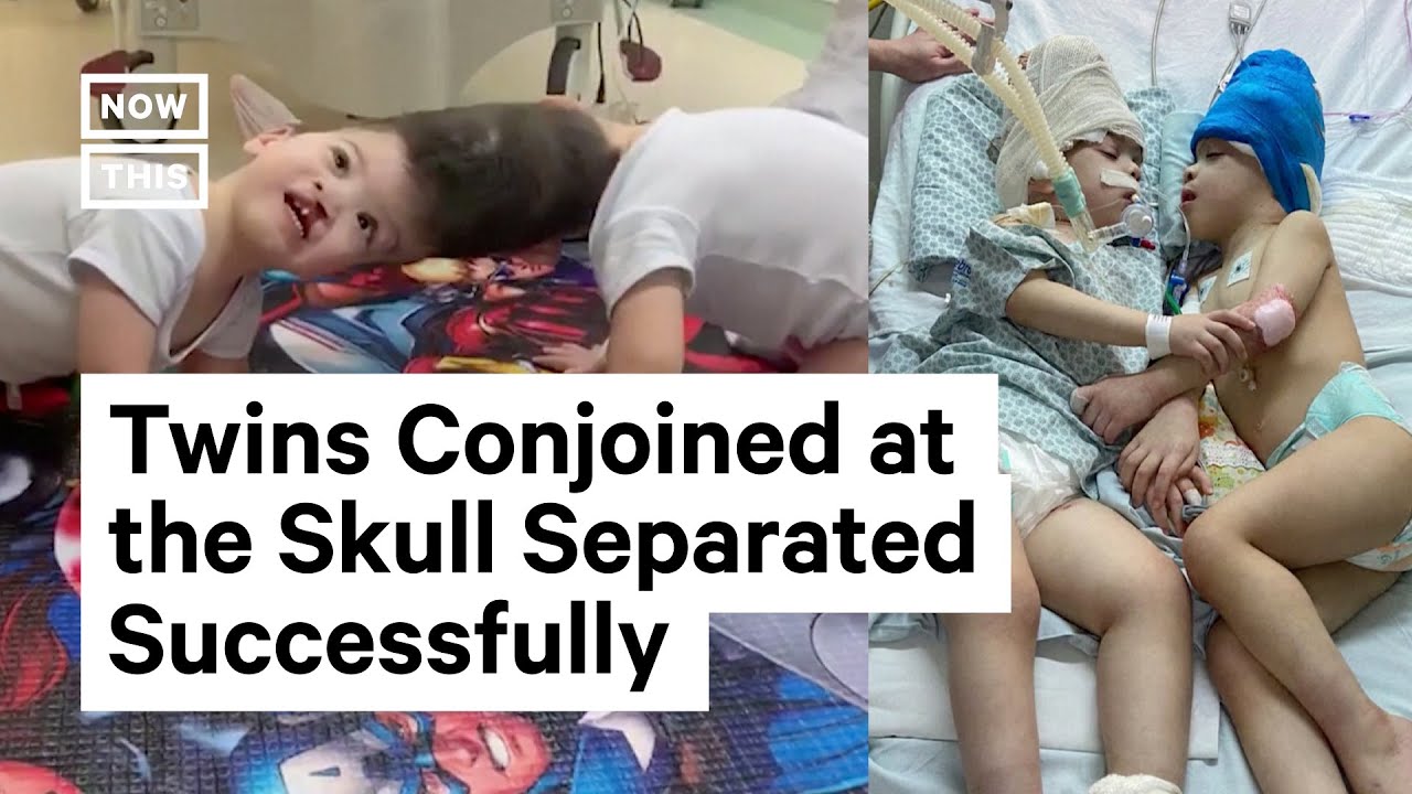 Conjoined Twins Separated After 27 Hour Surgery