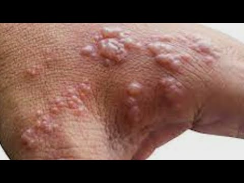 Doctor Says Monkeypox Patients Are Getting Misdiagnosed | Newsnation Prime