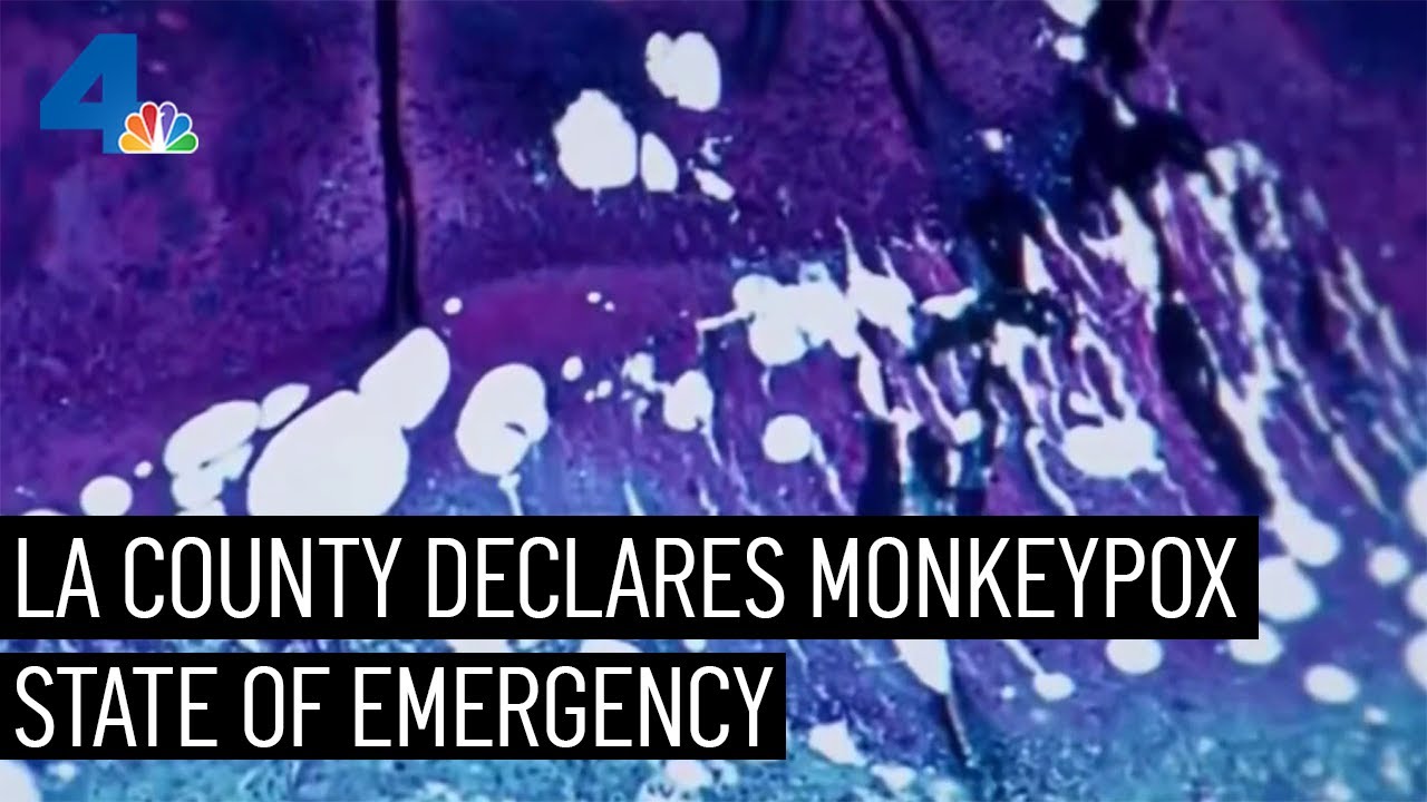 La County Declares Monkeypox State Of Emergency | Nbcla