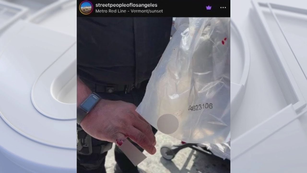 Homeless Person Allegedly Bites Off La Police Officer’s Finger On Santa Monica Blvd.