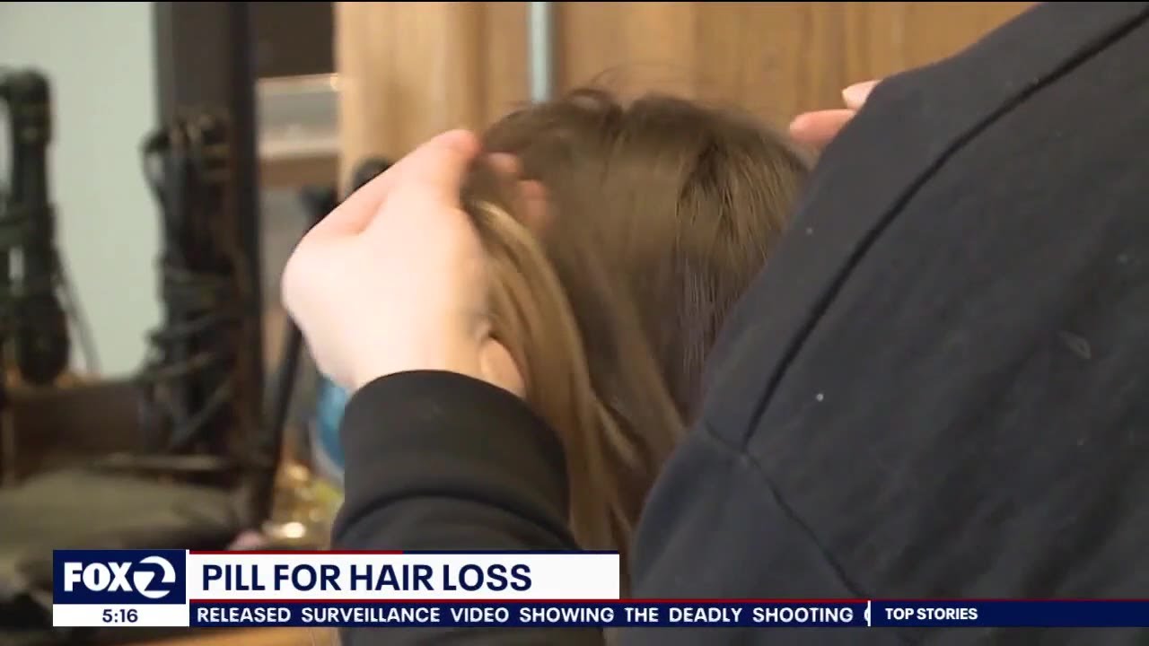 Hair loss helped by blood pressure medication 1 Hair Loss Helped By Blood Pressure Medication