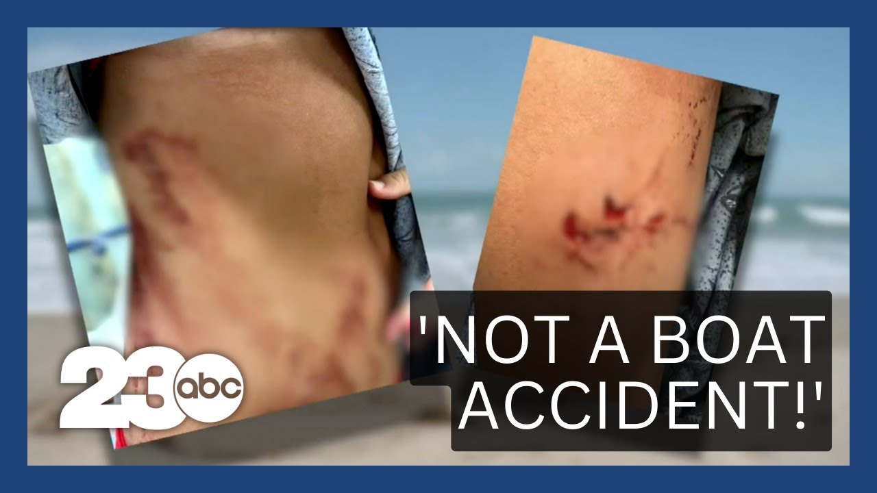 Teen Girl Survives Shark Attack