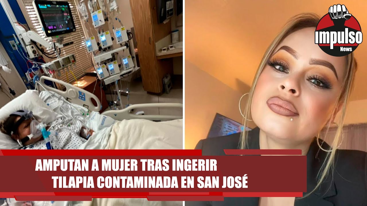 Amputan A Mujer Tras Ingerir Tilapia Contaminada En San JosÉ | Impulso News