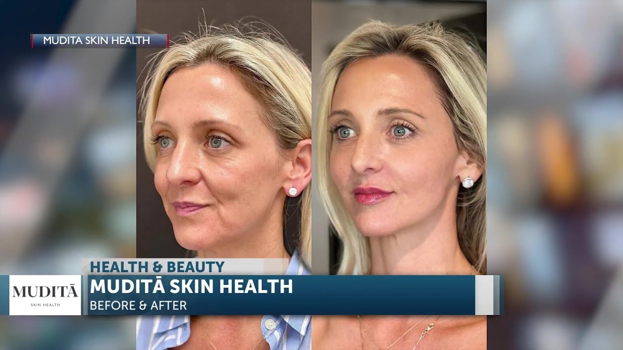 Polly Dursum drops by the Morning News to tell us about her skin care clinic Mudita Skin ... 2 Polly Dursum Drops By The Morning News To Tell Us About Her Skin Care Clinic Mudita Skin …