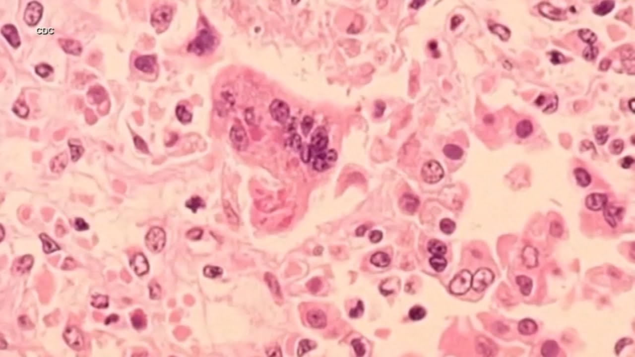 measles could be easier to get t