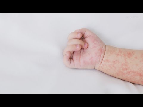 measles cases remain at 3 in wa
